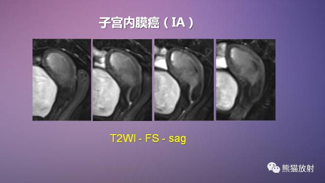 【PPT】女性盆腔肿瘤的MRI诊断