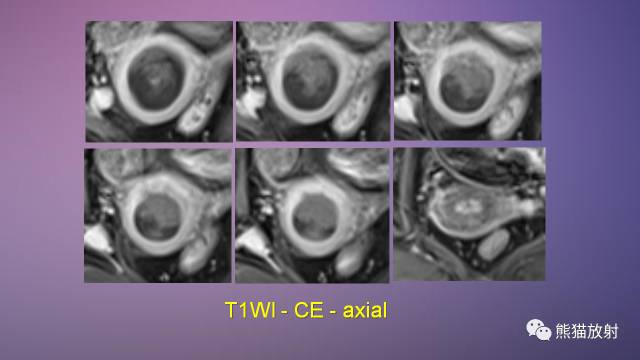 【PPT】女性盆腔肿瘤的MRI诊断