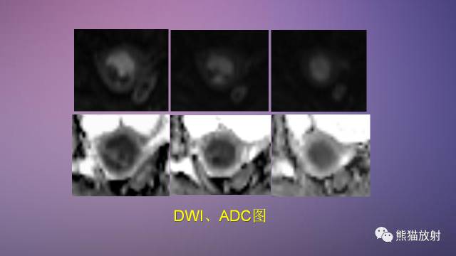 【PPT】女性盆腔肿瘤的MRI诊断