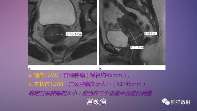 【PPT】女性盆腔肿瘤的MRI诊断