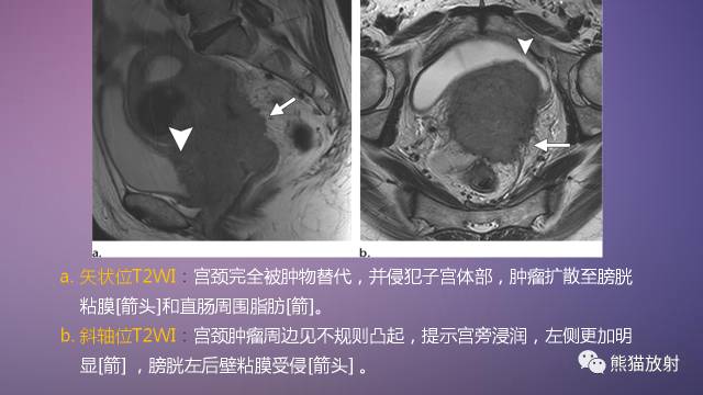【PPT】女性盆腔肿瘤的MRI诊断
