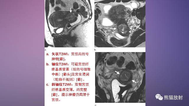 【PPT】女性盆腔肿瘤的MRI诊断