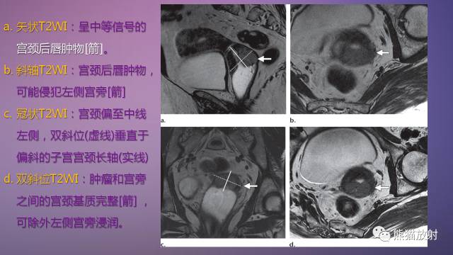 【PPT】女性盆腔肿瘤的MRI诊断