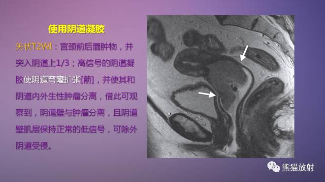 【PPT】女性盆腔肿瘤的MRI诊断