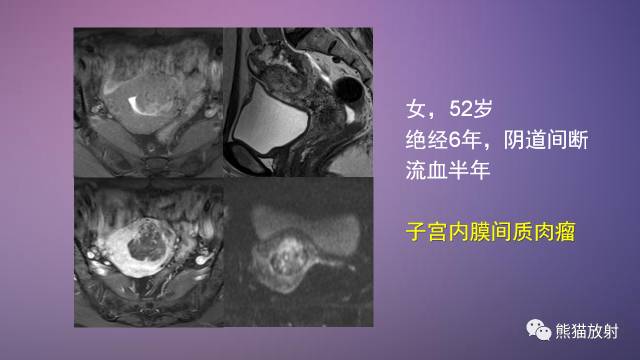【PPT】女性盆腔肿瘤的MRI诊断