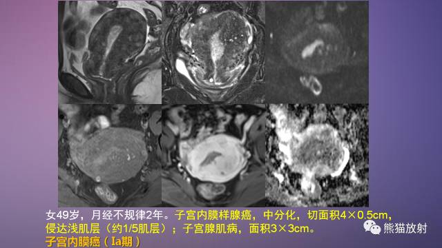 【PPT】女性盆腔肿瘤的MRI诊断