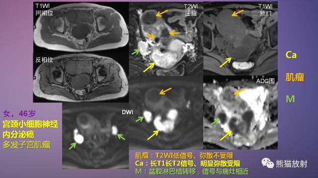 【PPT】女性盆腔肿瘤的MRI诊断