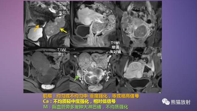 【PPT】女性盆腔肿瘤的MRI诊断