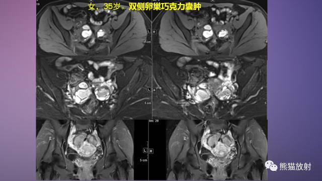 【PPT】女性盆腔肿瘤的MRI诊断