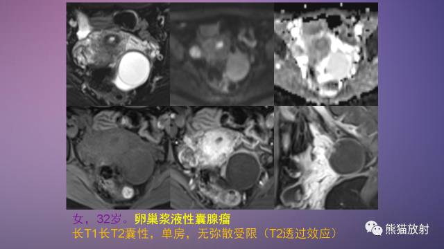 【PPT】女性盆腔肿瘤的MRI诊断