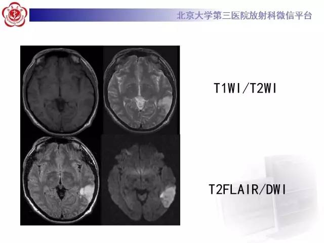 【病例】烟雾病2例影像表现