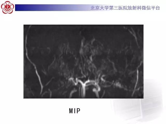 【病例】烟雾病2例影像表现