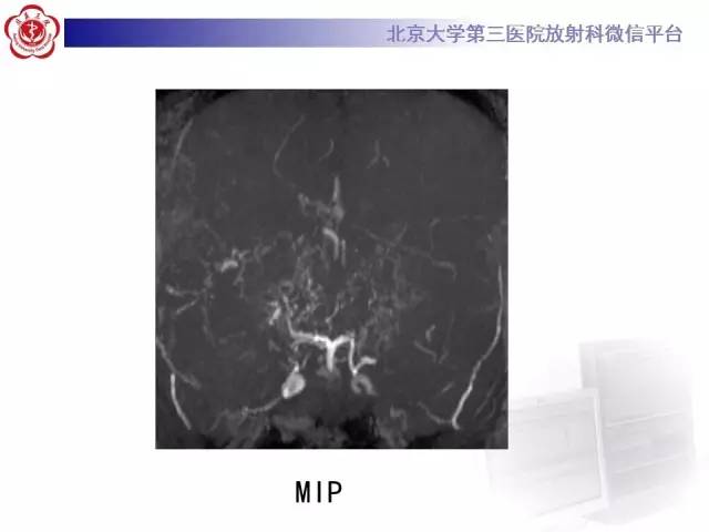【病例】烟雾病2例影像表现