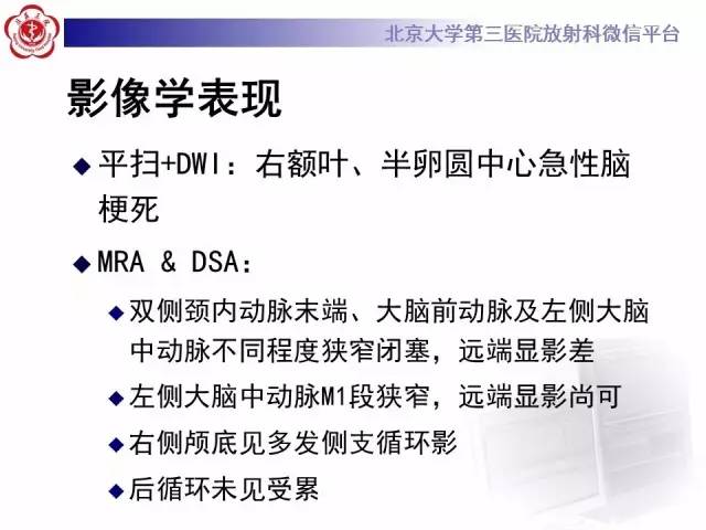 【病例】烟雾病2例影像表现