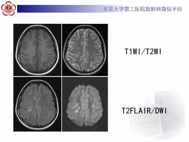 【病例】烟雾病2例影像表现