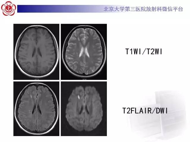 【病例】烟雾病2例影像表现