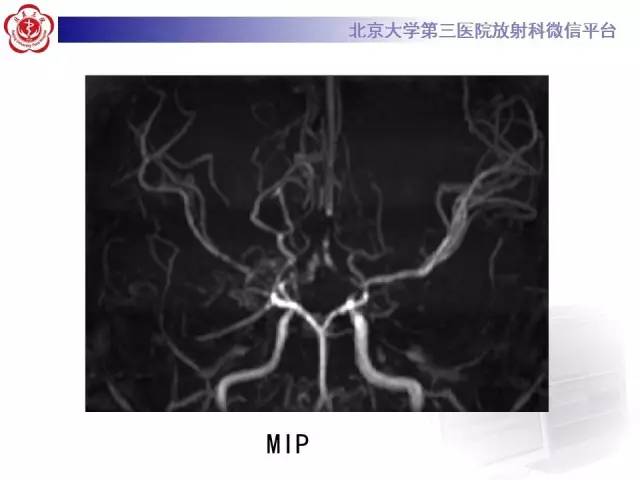 【病例】烟雾病2例影像表现