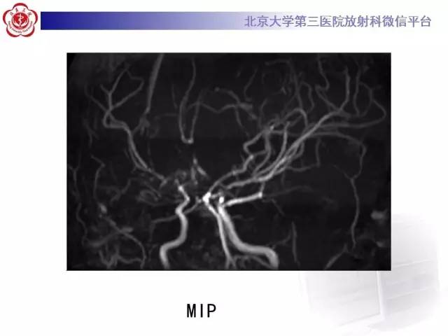 【病例】烟雾病2例影像表现