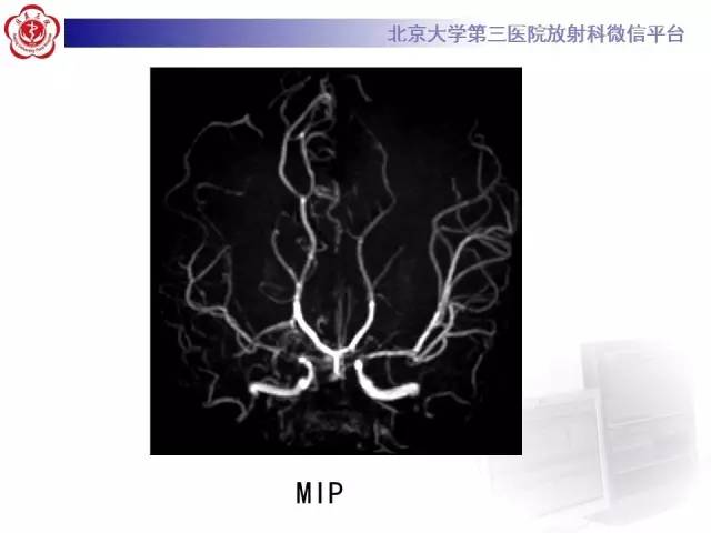 【病例】烟雾病2例影像表现