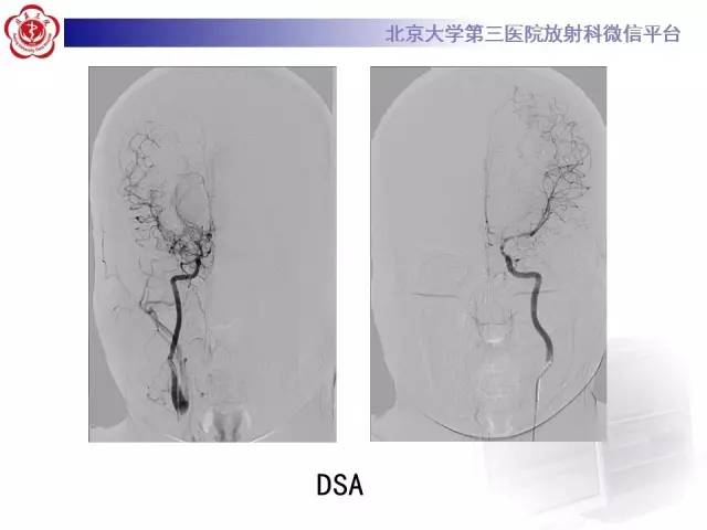 【病例】烟雾病2例影像表现