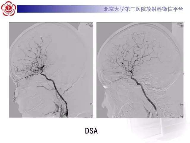 【病例】烟雾病2例影像表现