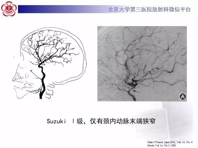 【病例】烟雾病2例影像表现