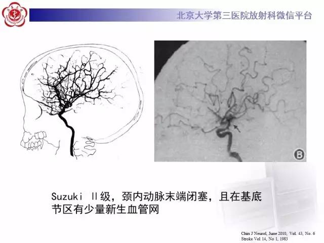 【病例】烟雾病2例影像表现