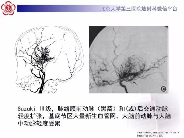 【病例】烟雾病2例影像表现