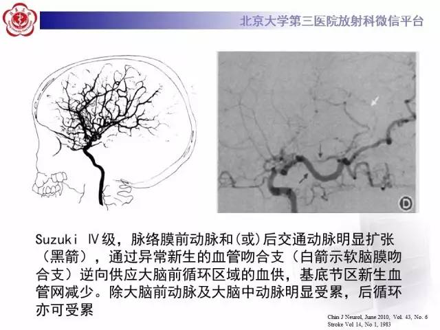 【病例】烟雾病2例影像表现