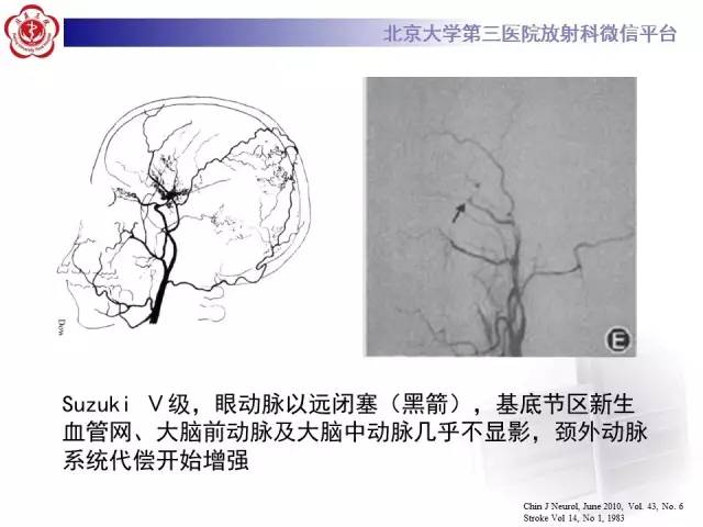 【病例】烟雾病2例影像表现