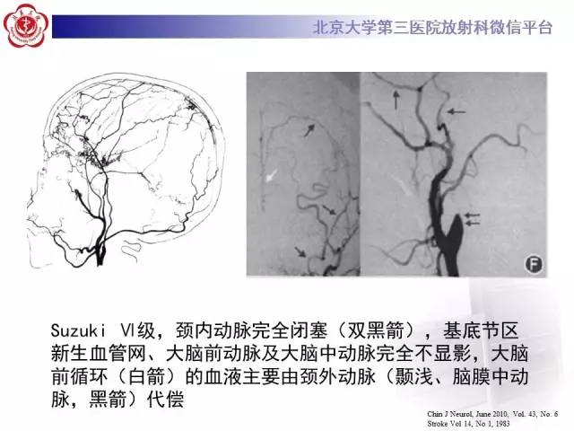【病例】烟雾病2例影像表现