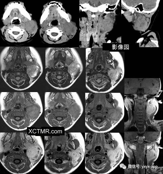 【病例】颈部淋巴结结核1例CT及MRI