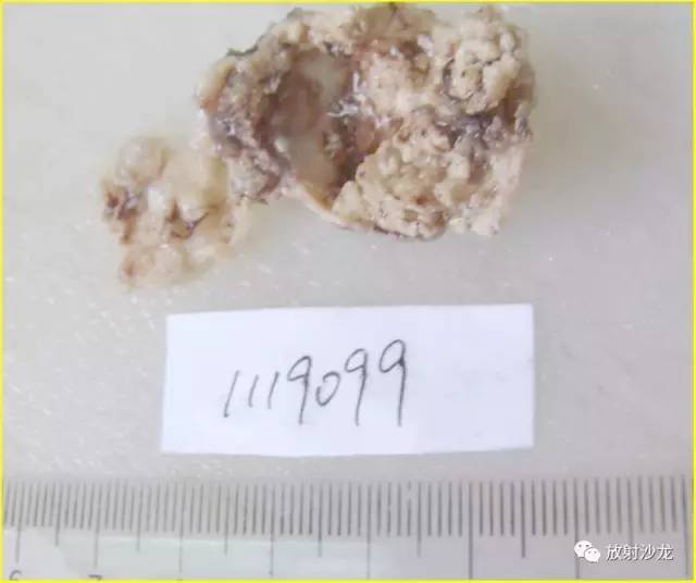 【病例】鞍旁颅咽管瘤1例MR 【病例】鞍旁颅咽管瘤1例MR