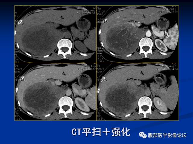 【病例】腹膜后胚胎性横纹肌肉瘤1例CT