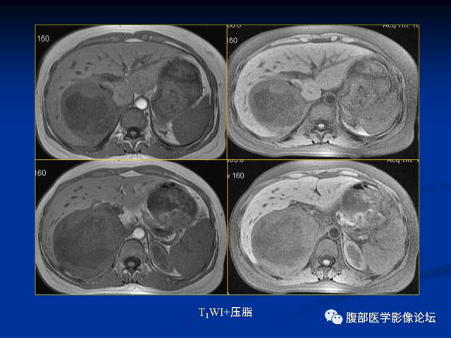 【病例】腹膜后胚胎性横纹肌肉瘤1例CT