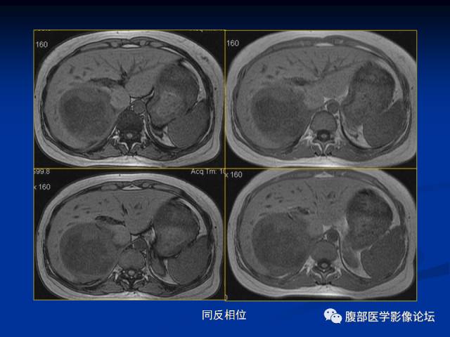 【病例】腹膜后胚胎性横纹肌肉瘤1例CT