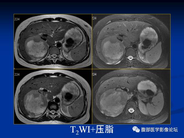 【病例】腹膜后胚胎性横纹肌肉瘤1例CT