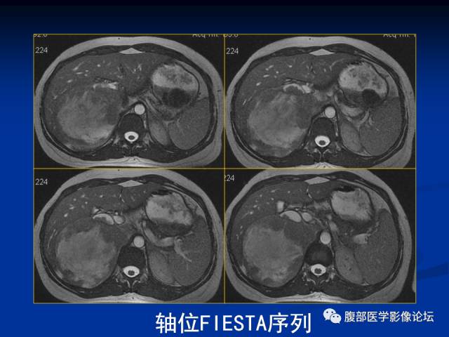 【病例】腹膜后胚胎性横纹肌肉瘤1例CT