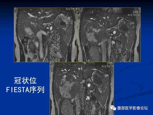 【病例】腹膜后胚胎性横纹肌肉瘤1例CT