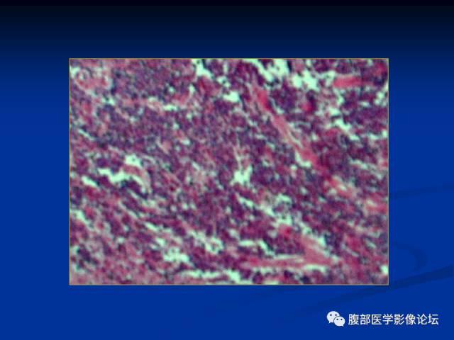 【病例】腹膜后胚胎性横纹肌肉瘤1例CT