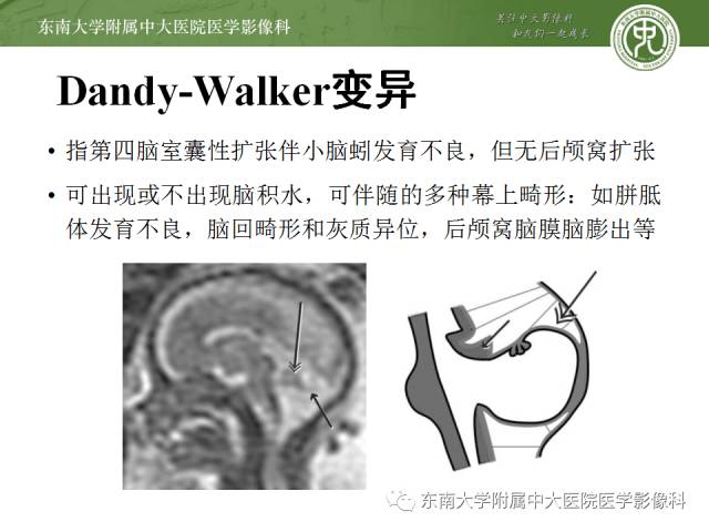 【病例】Dandy-Walker综合征1例MR