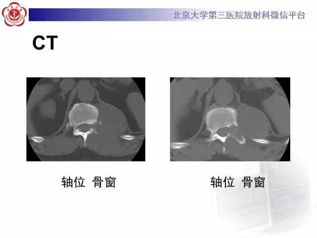 【病例】胸椎孤立性纤维瘤1例CT及MR