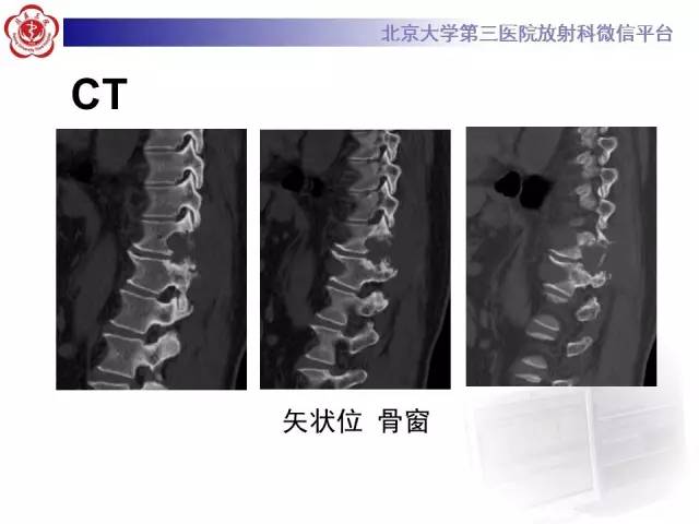 【病例】胸椎孤立性纤维瘤1例CT及MR