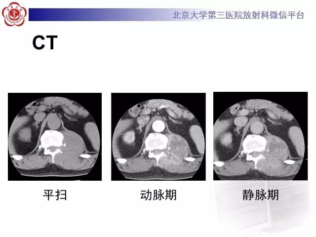【病例】胸椎孤立性纤维瘤1例CT及MR