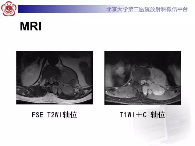 【病例】胸椎孤立性纤维瘤1例CT及MR