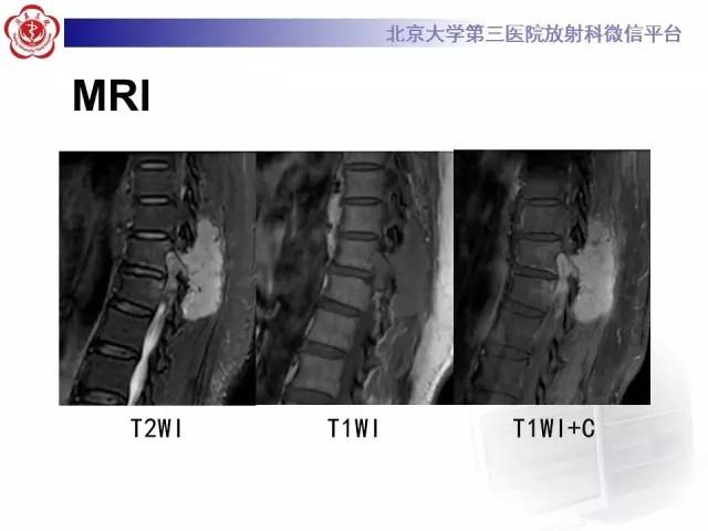 【病例】胸椎孤立性纤维瘤1例CT及MR