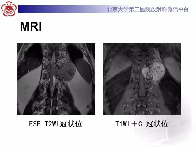 【病例】胸椎孤立性纤维瘤1例CT及MR