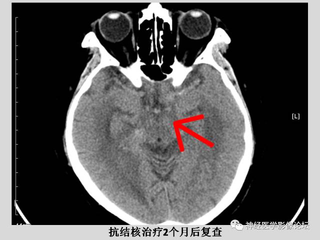 【PPT】颅内结核