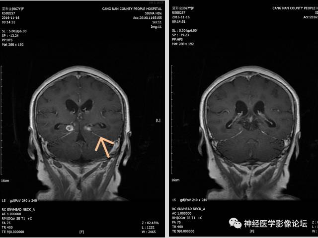 【PPT】颅内结核