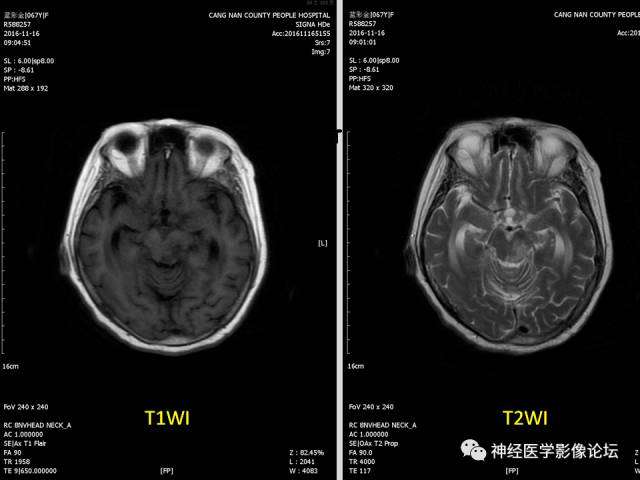 【PPT】颅内结核